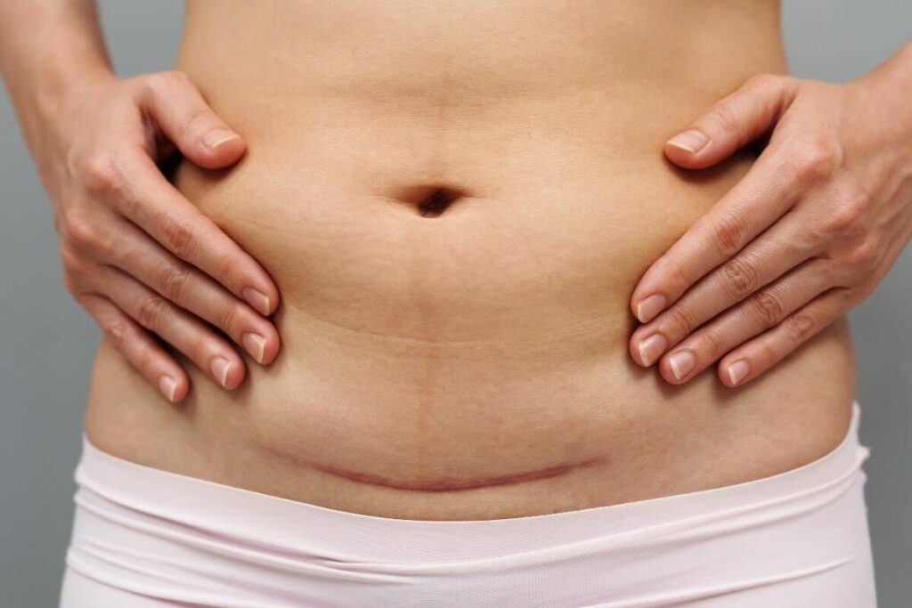 Caring for C-section scars | The Western Producer
