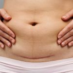 A C-section scar.